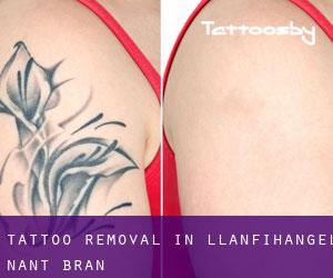 Tattoo Removal in Llanfihangel-Nant-Brân
