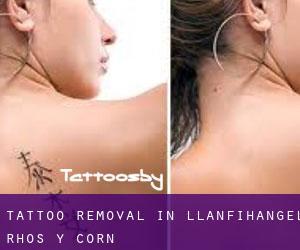 Tattoo Removal in Llanfihangel-Rhos-y-corn