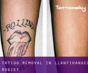 Tattoo Removal in Llanfihangel Rogiet