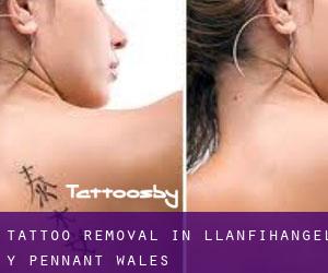 Tattoo Removal in Llanfihangel-y-Pennant (Wales)