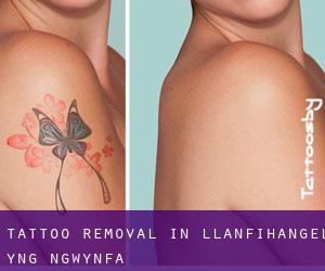 Tattoo Removal in Llanfihangel-yng-Ngwynfa