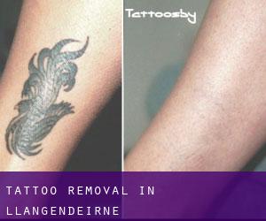 Tattoo Removal in Llangendeirne
