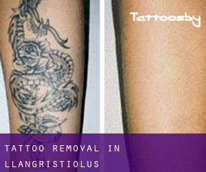 Tattoo Removal in Llangristiolus