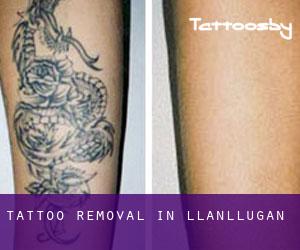 Tattoo Removal in Llanllugan