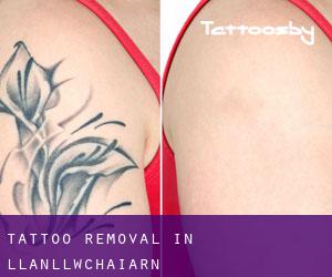 Tattoo Removal in Llanllwchaiarn