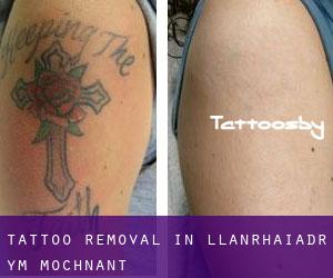 Tattoo Removal in Llanrhaiadr-ym-Mochnant