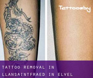 Tattoo Removal in Llansaintfraed in Elvel