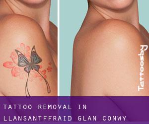 Tattoo Removal in Llansantffraid Glan Conwy
