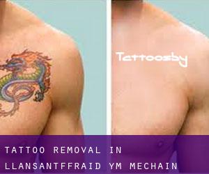 Tattoo Removal in Llansantffraid-ym-Mechain