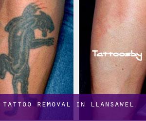Tattoo Removal in Llansawel