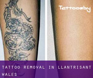 Tattoo Removal in Llantrisant (Wales)