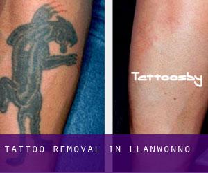 Tattoo Removal in Llanwonno
