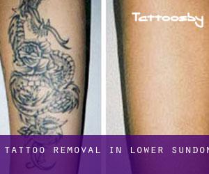 Tattoo Removal in Lower Sundon