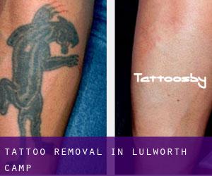 Tattoo Removal in Lulworth Camp