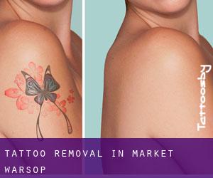 Tattoo Removal in Market Warsop
