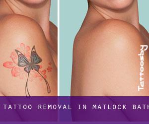 Tattoo Removal in Matlock Bath