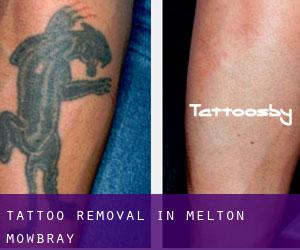 Tattoo Removal in Melton Mowbray