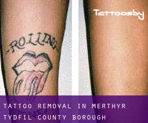 Tattoo Removal in Merthyr Tydfil (County Borough)