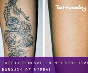 Tattoo Removal in Metropolitan Borough of Wirral