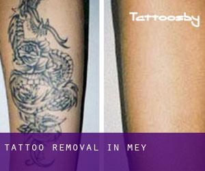 Tattoo Removal in Mey
