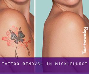 Tattoo Removal in Micklehurst