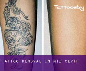 Tattoo Removal in Mid Clyth