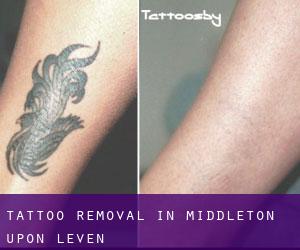Tattoo Removal in Middleton upon Leven