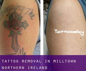Tattoo Removal in Milltown (Northern Ireland)