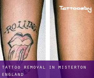 Tattoo Removal in Misterton (England)