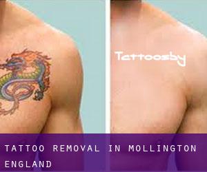 Tattoo Removal in Mollington (England)