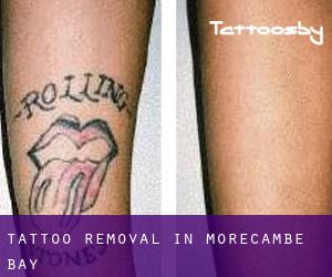 Tattoo Removal in Morecambe Bay