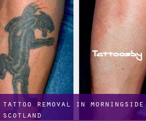 Tattoo Removal in Morningside (Scotland)