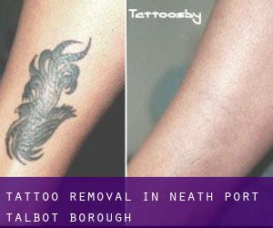 Tattoo Removal in Neath Port Talbot (Borough)