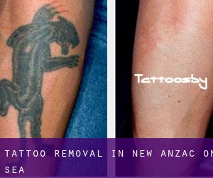 Tattoo Removal in New Anzac-on-Sea