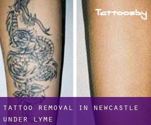Tattoo Removal in Newcastle-under-Lyme