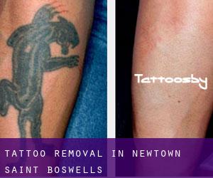 Tattoo Removal in Newtown Saint Boswells