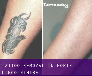 Tattoo Removal in North Lincolnshire