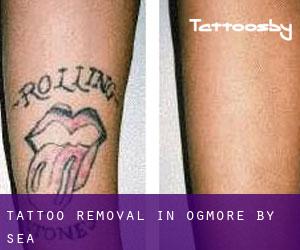 Tattoo Removal in Ogmore-by-Sea