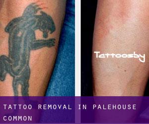 Tattoo Removal in Palehouse Common