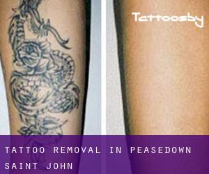 Tattoo Removal in Peasedown Saint John