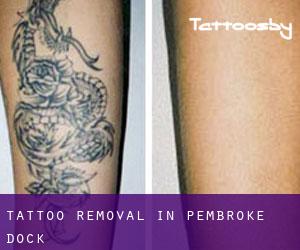 Tattoo Removal in Pembroke Dock