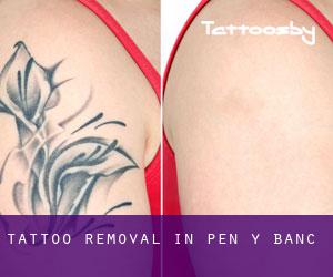 Tattoo Removal in Pen-y-banc