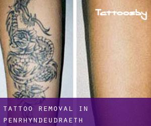Tattoo Removal in Penrhyndeudraeth