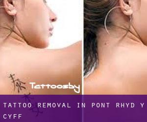 Tattoo Removal in Pont Rhyd-y-cyff