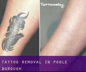 Tattoo Removal in Poole (Borough)