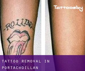 Tattoo Removal in Portachoillan