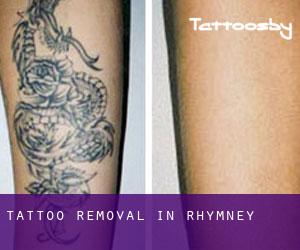 Tattoo Removal in Rhymney