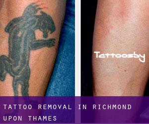 Tattoo Removal in Richmond upon Thames