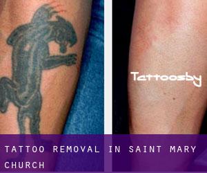 Tattoo Removal in Saint Mary Church