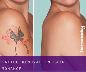 Tattoo Removal in Saint Monance